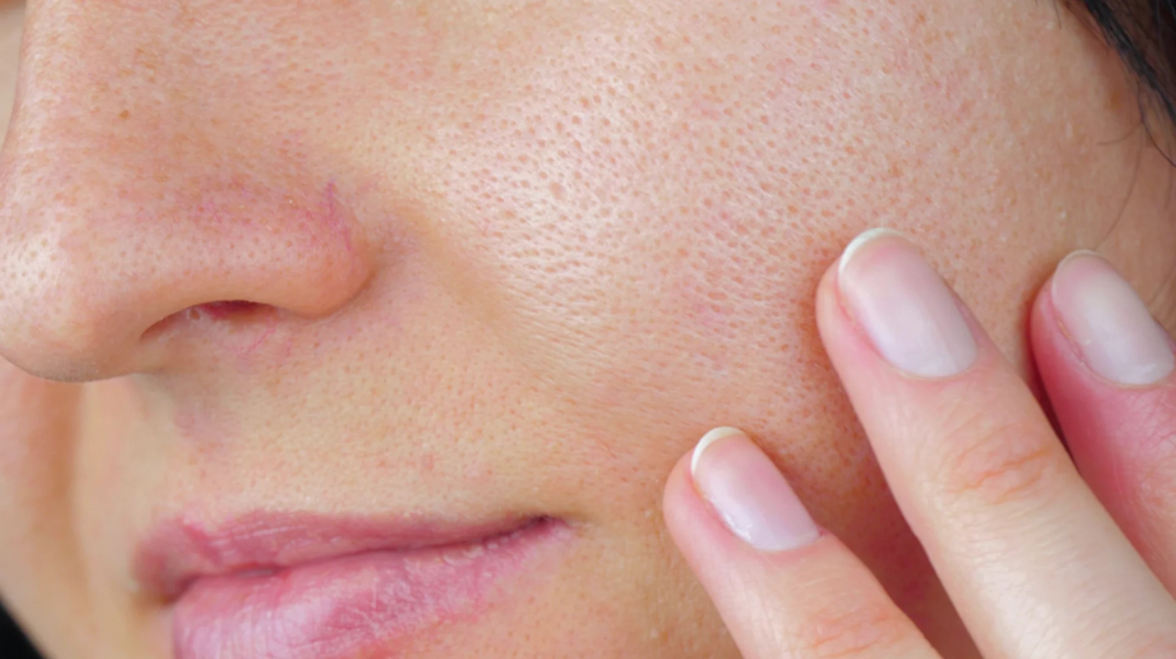 Can You Really Get Rid of Open Pores? Here’s the Truth