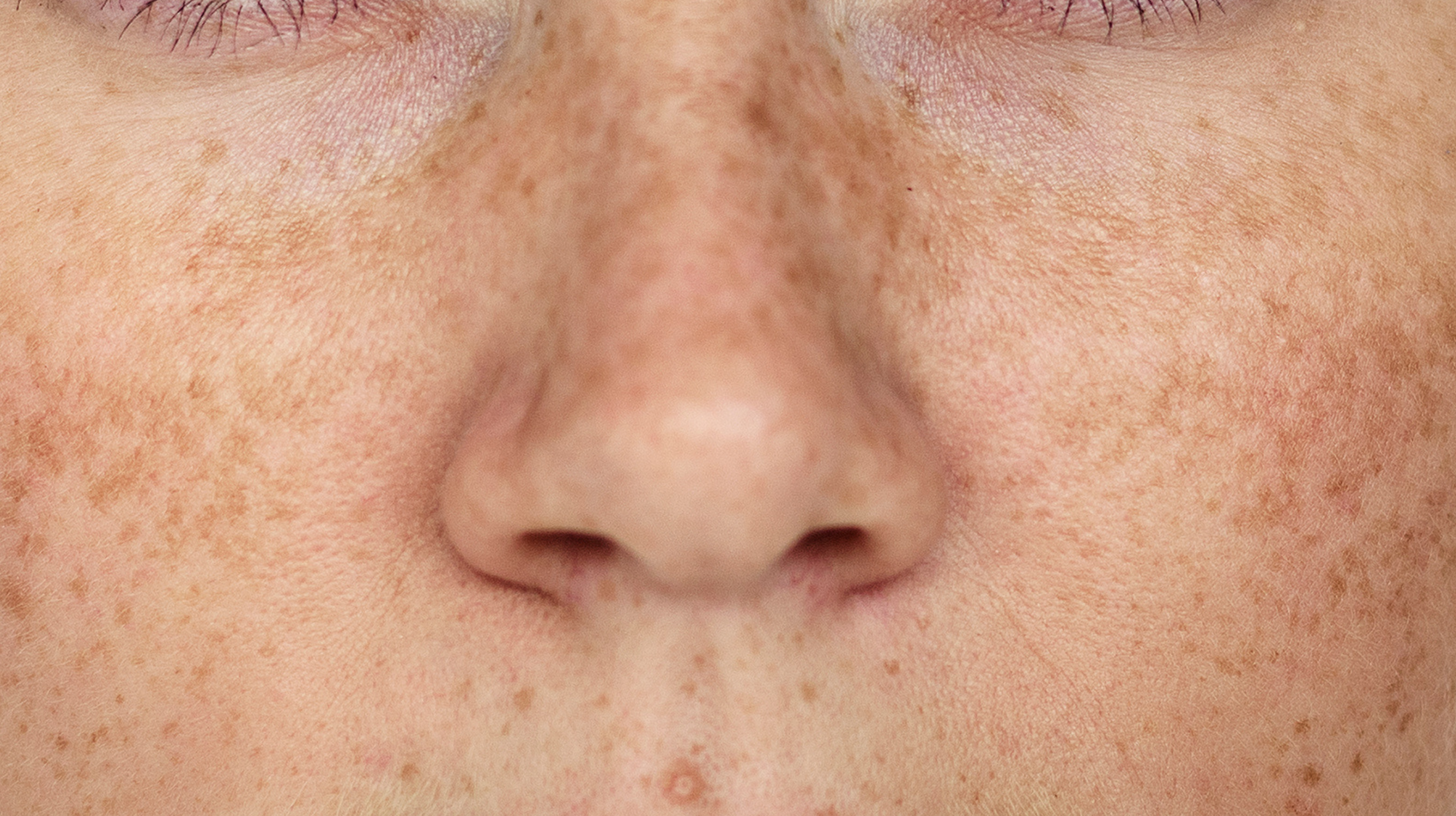 Hyperpigmentation Isn’t Just One Thing: 4 Types & How to Tackle Them