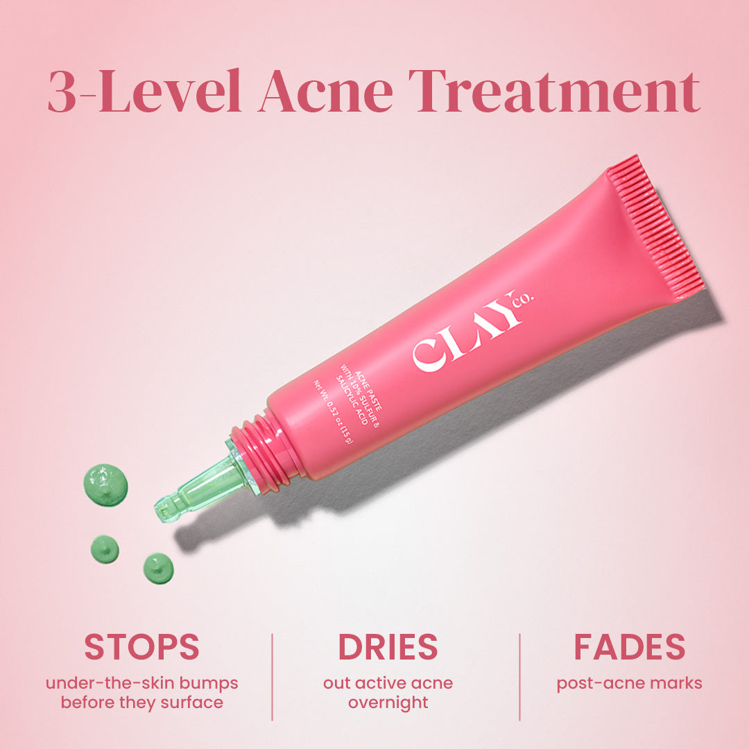 Acne Paste with 10% Sulfur & Salicylic Acid | 15g